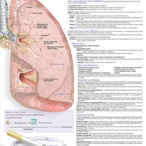 Understanding Lung Cancer Chart