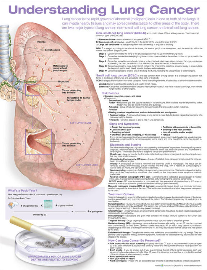 Understanding Lung Cancer Chart