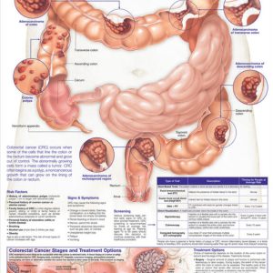 Understanding Colorectal Cancer Chart