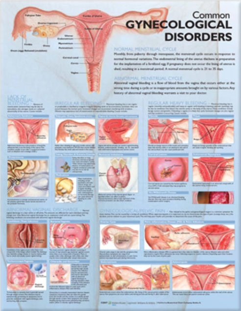 Common Gynecological Disorders Chart