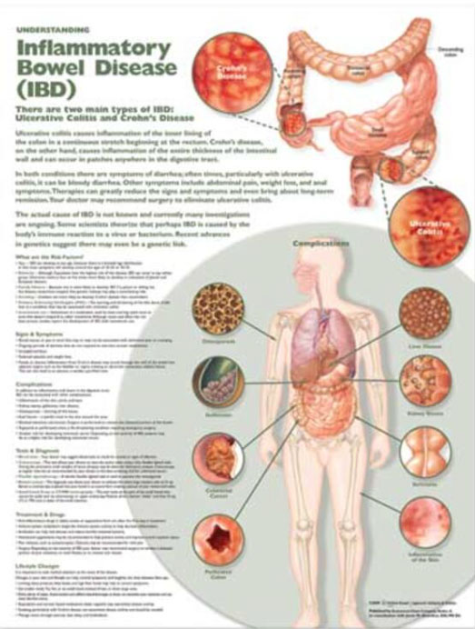 Understanding Inflammatory Bowel Disorder Chart