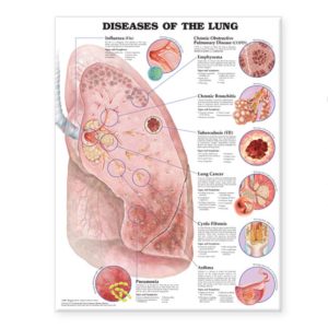 Diseases of the Lung Chart