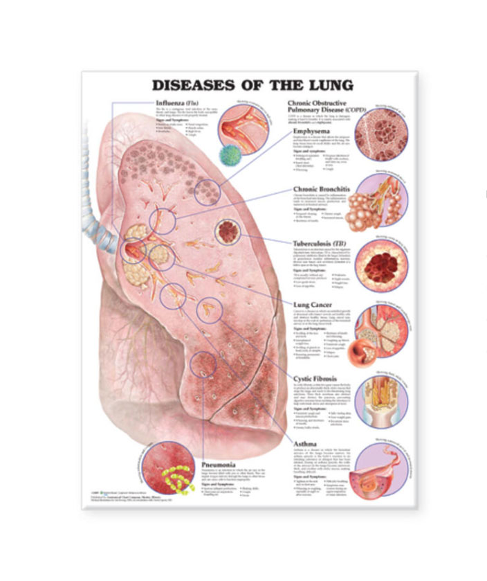 Diseases of the Lung Chart