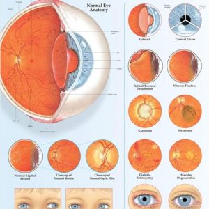 Disorders of the Eye Chart