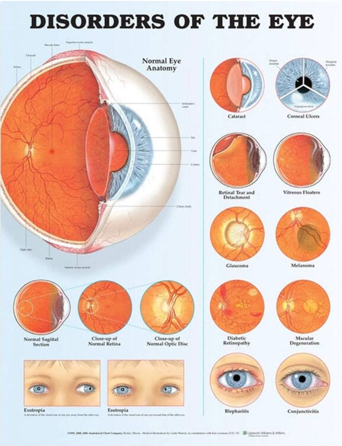 Disorders of the Eye Chart
