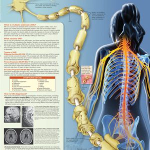 Understanding Multiple Sclerosis Chart