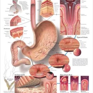 Understanding Ulcers Chart