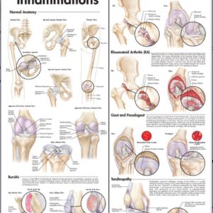Hip and Knee Inflammations Chart