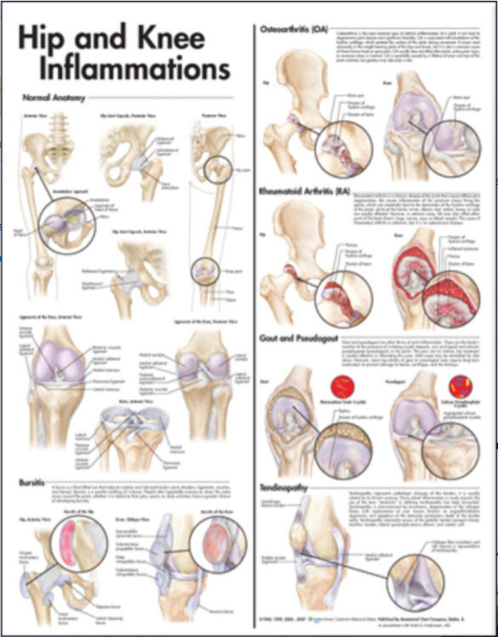 Hip and Knee Inflammations Chart