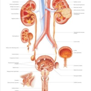 Diseases of the Urinary Tract Chart