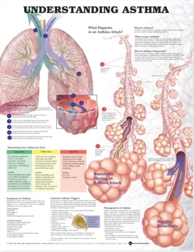 Understanding Asthma Chart
