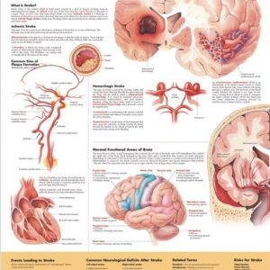 Understanding Stroke Chart