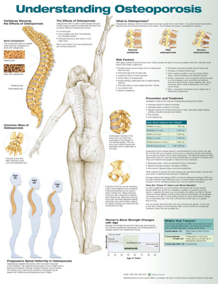 Understanding Osteoporosis Chart