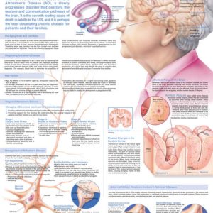 Understanding Alzheimer's Chart