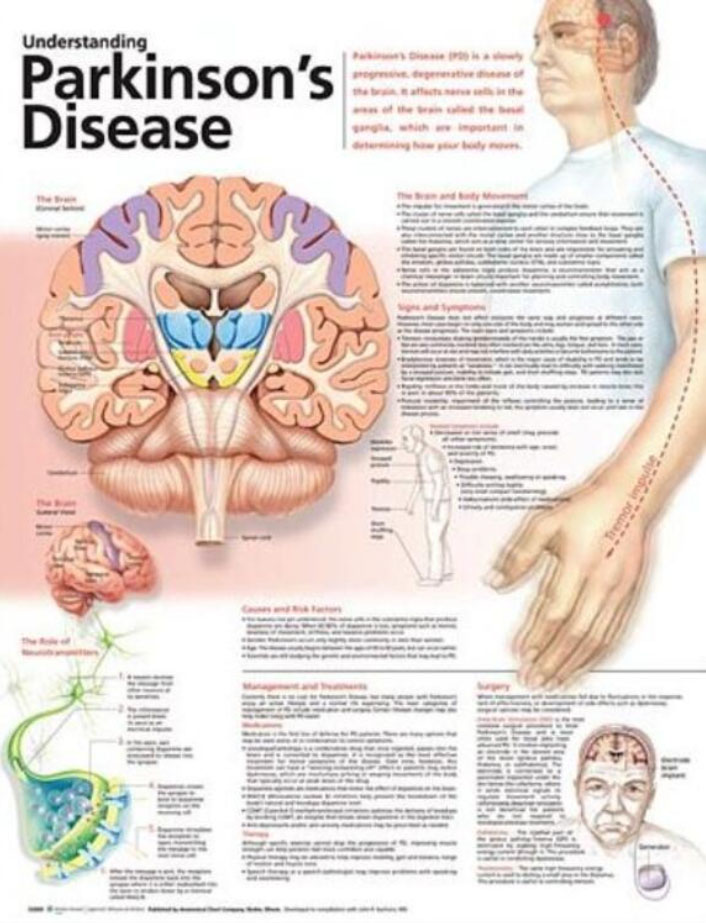 Understanding Parkinson’s Disease Chart