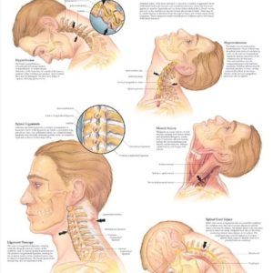 Whiplash Injuries of the Head and Neck Chart