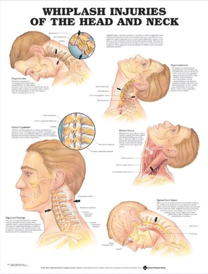 Whiplash Injuries of the Head and Neck Chart