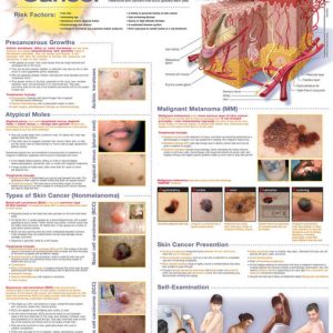 Understanding Skin Cancer Chart