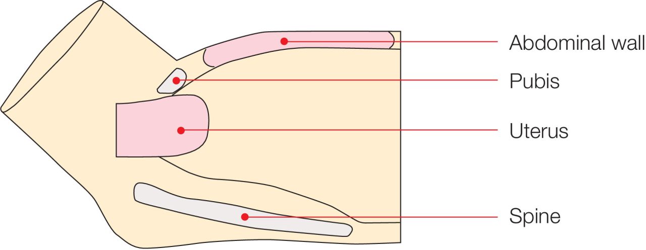 Puerperal Uterus Palpation Training Model