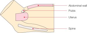 Puerperal Uterus Palpation Training Model