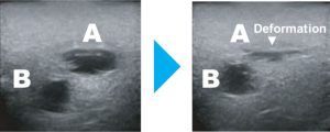 Central Venous Puncture Trainer