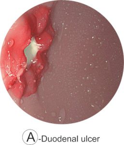 Esophago-Gastro-Duodenoscopy (EGD) Simulator