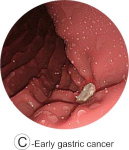 Esophago-Gastro-Duodenoscopy (EGD) Simulator
