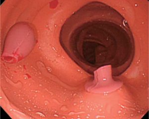 Colonoscopy (Lower GI Endoscopy) Simulator Type II