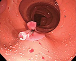 Colonoscopy (Lower GI Endoscopy) Simulator Type II