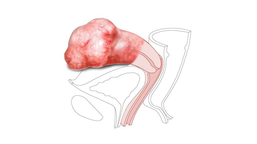 Module 2: Large Fibroid – Nulliparous Ectropian Cervix