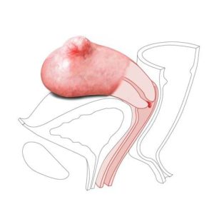 CFPT Mk 3 Module 3: Small Fibroid - Nulliparous Polyp Cervix, Light
