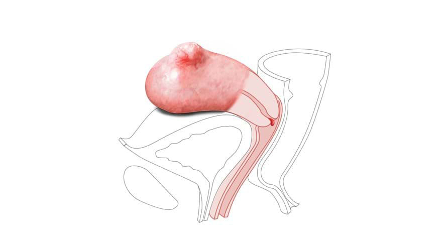 Module 3: Small Fibroid – Nulliparous Polyp Cervix