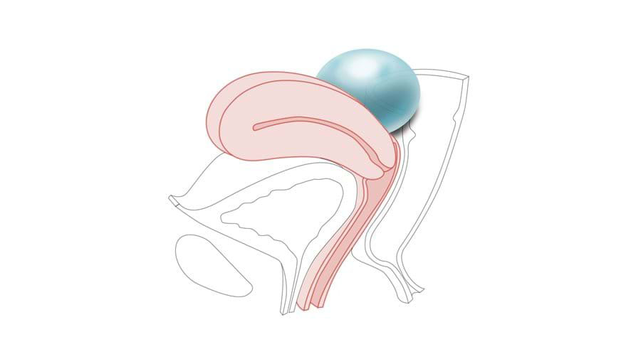 Module 4: Ovarian Cyst – Multiparous Cervix