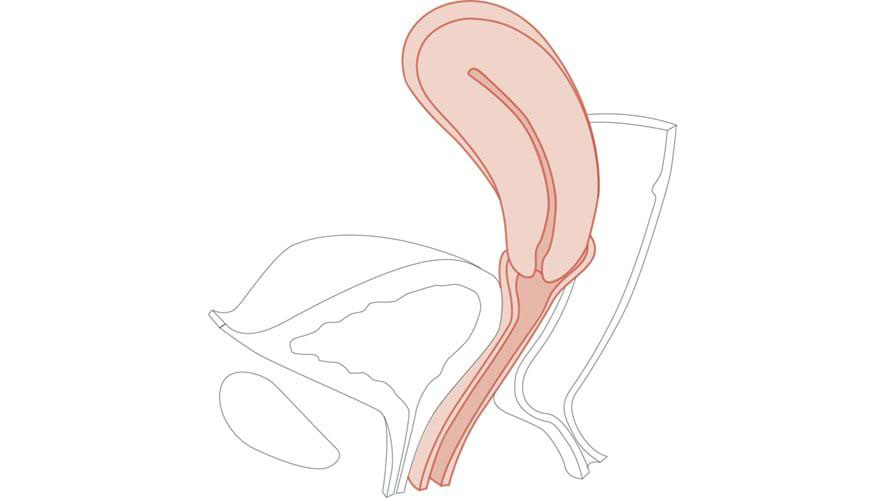 Module 5: Retroverted – Multiparous Cervix