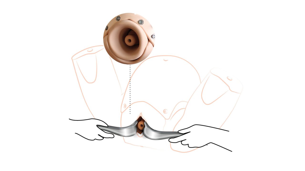 Prompt Flex Cervical Cerclage Module, Light (CCM)