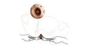 Prompt Flex Cervical Cerclage Module, Light (CCM)