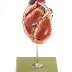 Model of the Heart With Bypass Vessels (Aortic Coronary Venous Bypass)