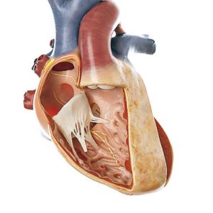 Transposition of Large Vessels