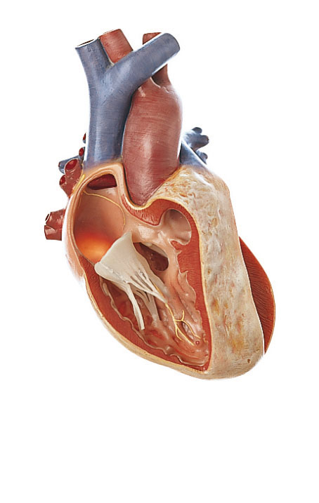 Fallot’s Tetralogy