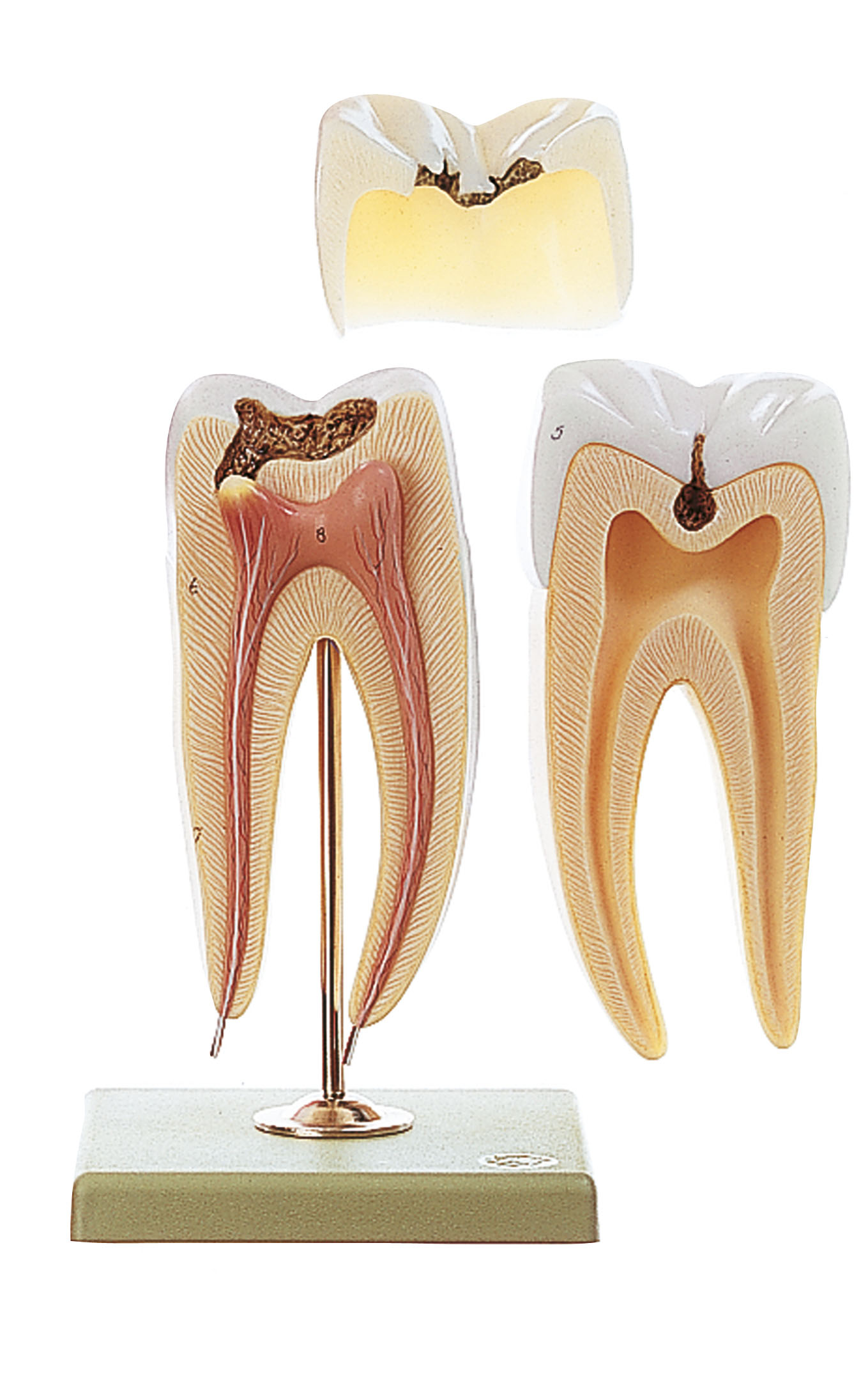 Molar Tooth With Caries