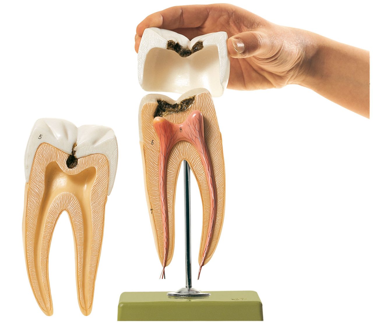 Molar Tooth With Caries