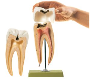Molar Tooth With Caries