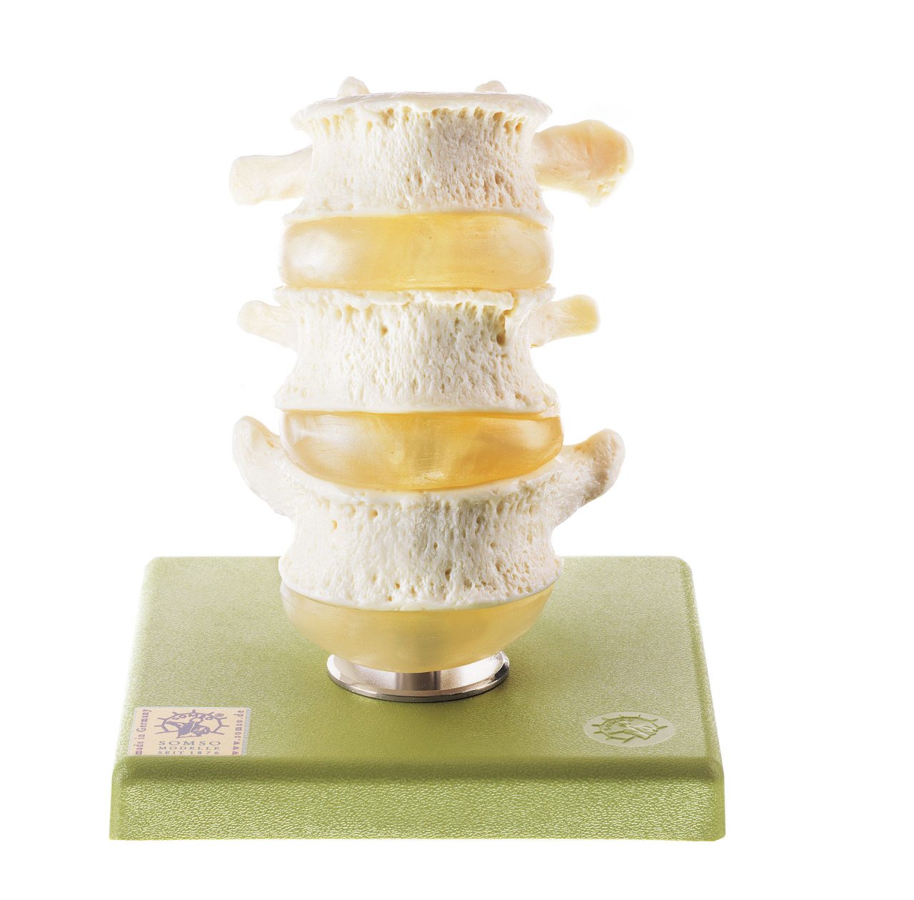 Three Lumbar Vertebrae With Discs