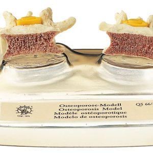 Osteoporosis Model