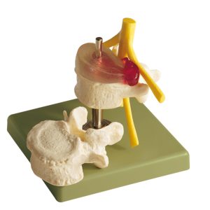 Hernia of Dorsolateral Intervertebral Disc
