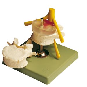 Hernia of Central Intervertebral Disc