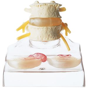 Central and Dorsolateral Herniated Disc