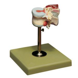 First Lumbar Vertebra With Herniated Discs and Dorsal Muscles