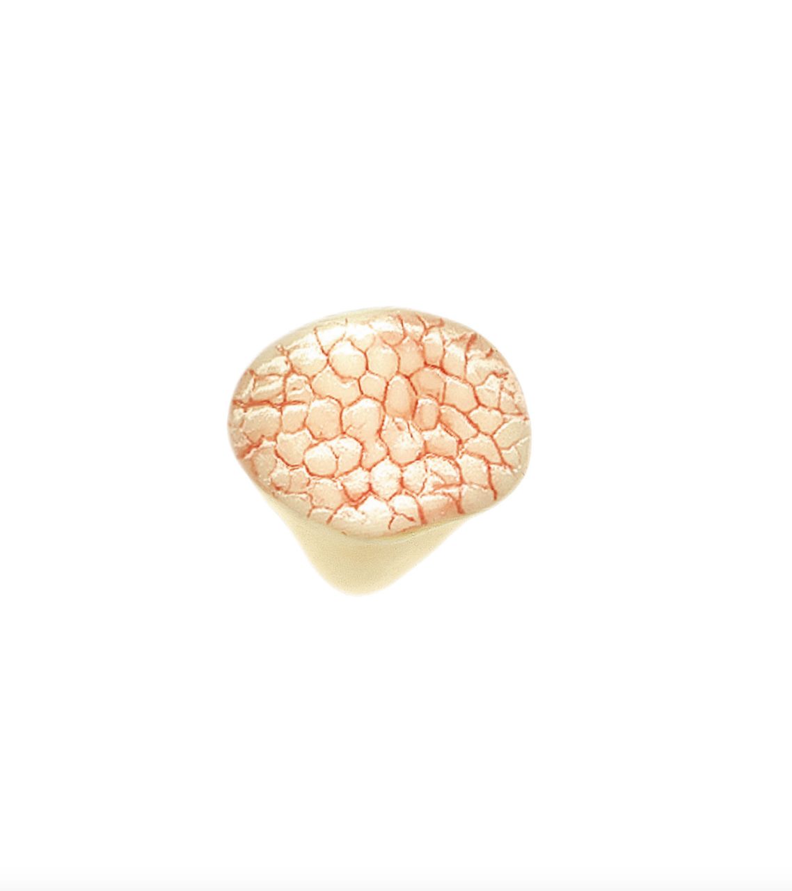 Patella With Tear Formation