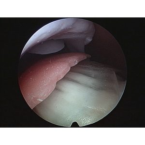 Arthroscopy Model of the Shoulder